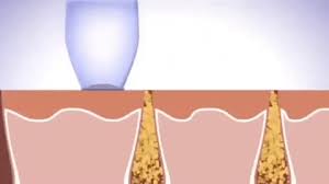 Aspiratore punti neri BlackHead