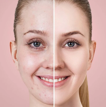 Aspiratore punti neri BlackHead